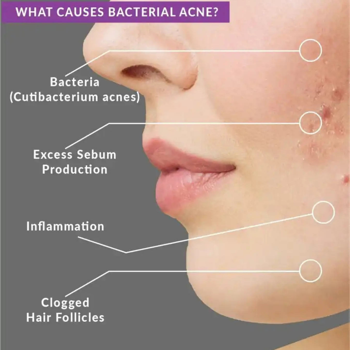 Beautenic Benzoyl Peroxide Acne Treatment Toner