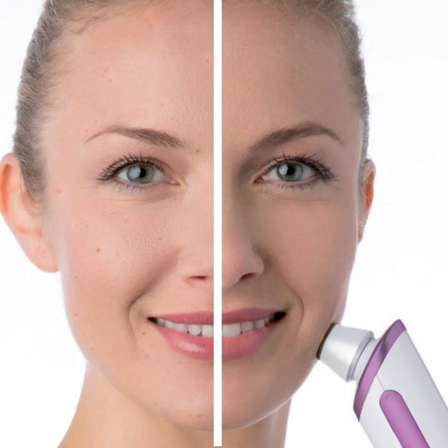 Beurer Microdermabrasion FC-76