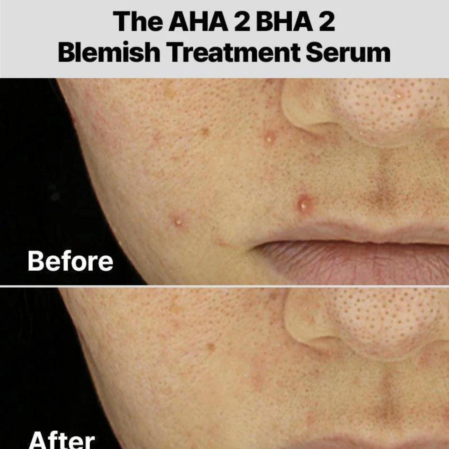 COSRX The AHA 2 BHA 2 Blemish Treatment Serum