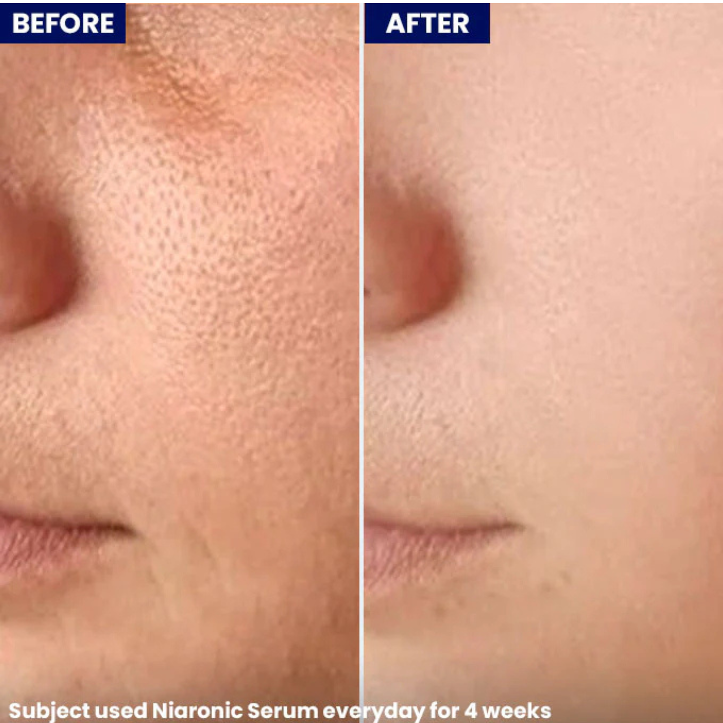 Jenpharm NiaRonic Acne Control Serum