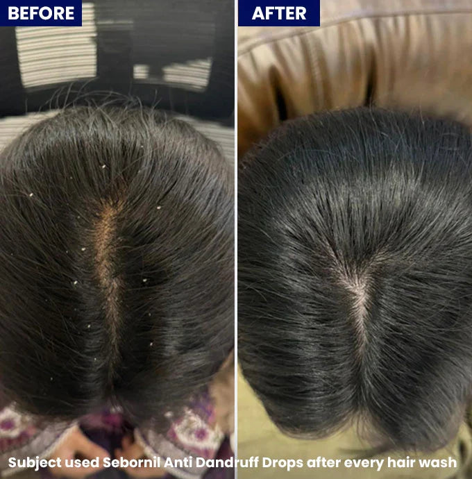 Jenpharm Sebornil Anti-Dandruff Drops For All Scalp Type 50ml